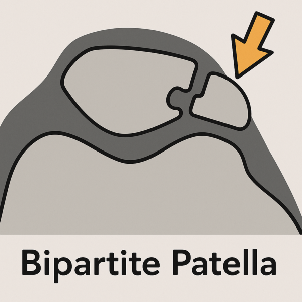 Bipartite Patella: A Rare but Important Cause of Anterior Knee Pain
