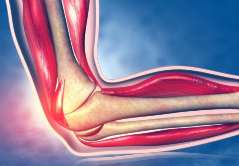 Dirsekte Triceps Tendon Yırtığı