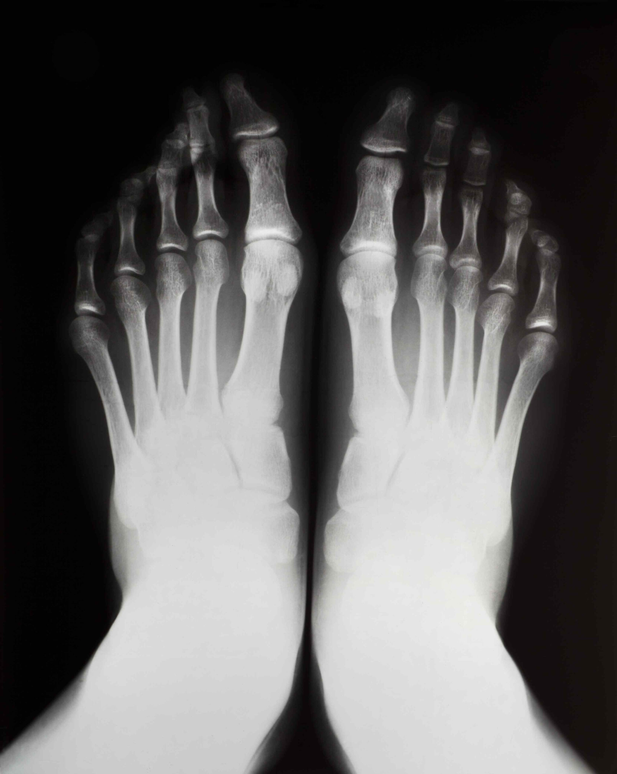 Halluks Valgus