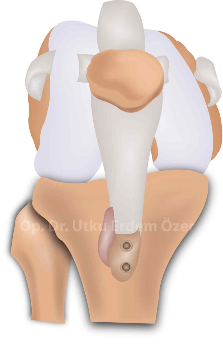Diz Kapağı Çıkığı Ameliyatı - Tibial Tüberkül Osteotomisi
