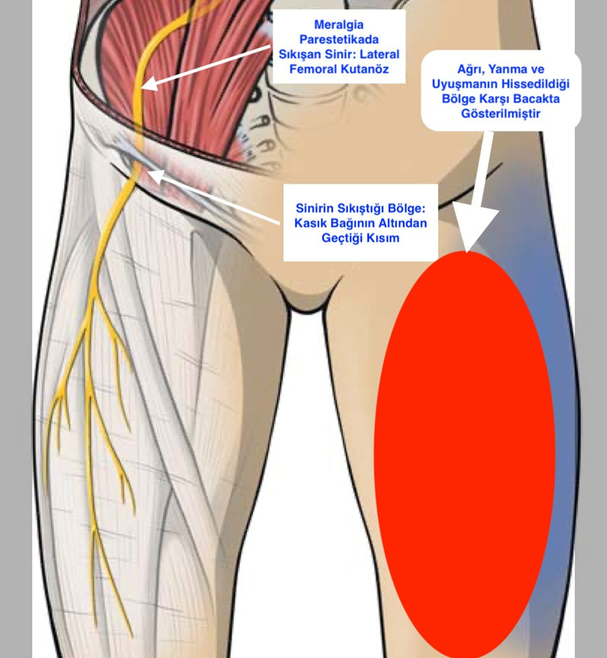 Meralgia Parestetika: Lateral Femoral Kuteneal Sinir Sıkışması