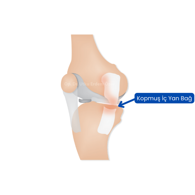Medial Collateral Ligament (MCL) Injury of the Knee
