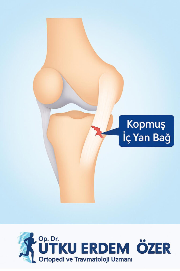 Diz İç Yan Bağ (Medial Kollateral Ligament) Zedelenmesi