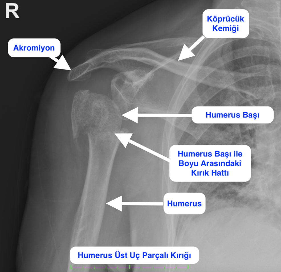 Humerus Üst Uç Kırığı | İyileşme Süresi