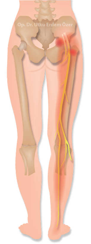 Piriformis Sendromu