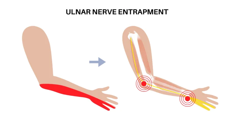 Ulnar Sinir Subluksasyonu