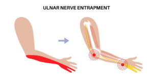 Ulnar Tunnel Syndrome of the Wrist