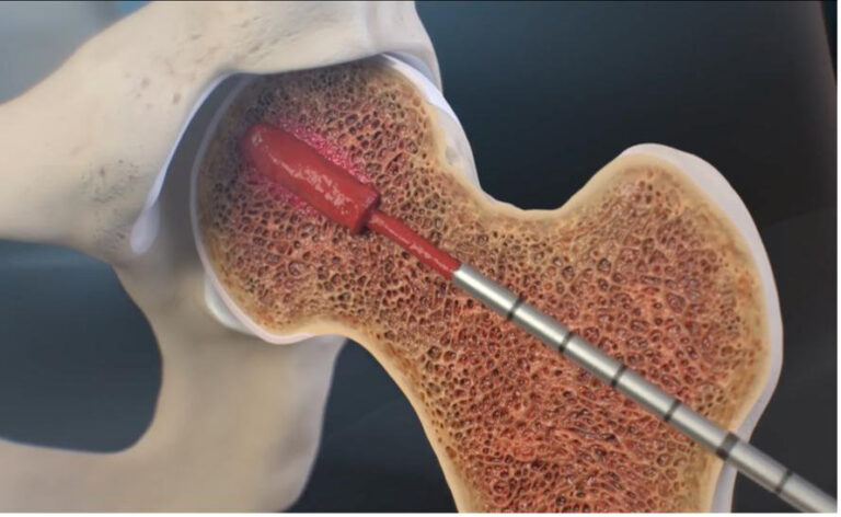 Intraosseöz Bioplasti