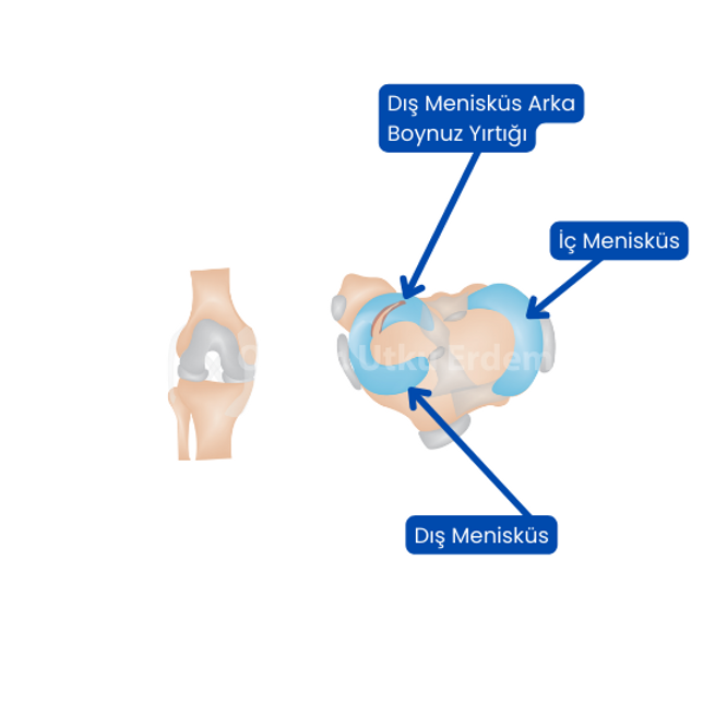Diskoid Menisküs Nedir?