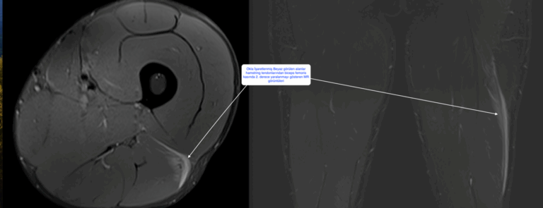 Hamstring Muscle Tear Treatment