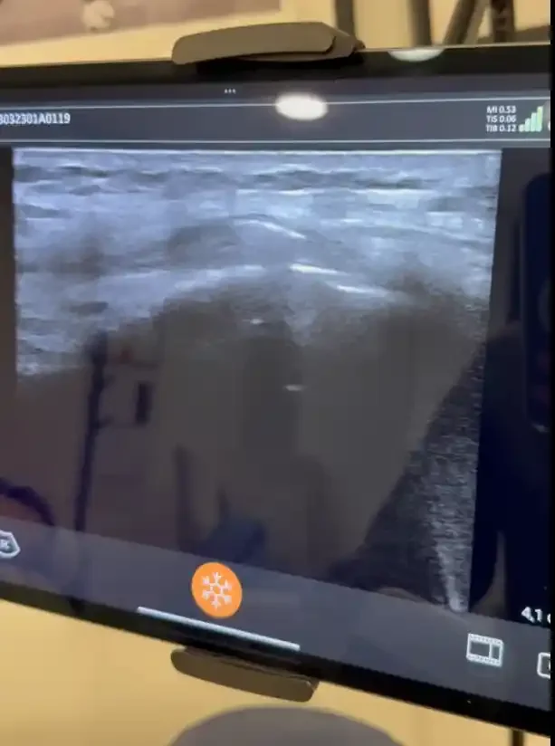 Ultrason Eşliğinde İğne Tedavileri