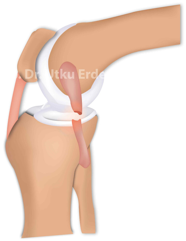 Dizin Dış Yan (Lateral Kollateral) Bağ Yaralanmaları