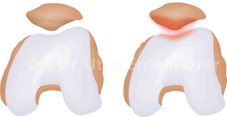 Kondromalazi Patella