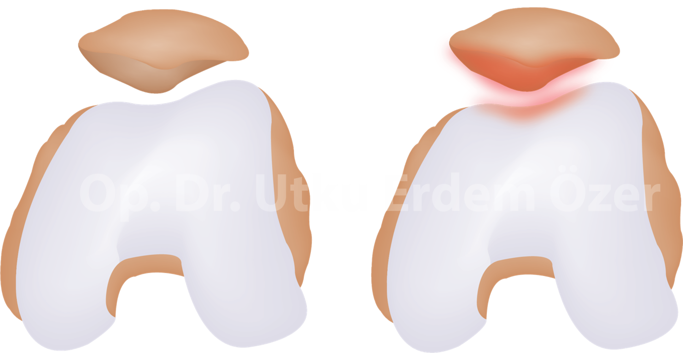 Kondromalazi Patella
