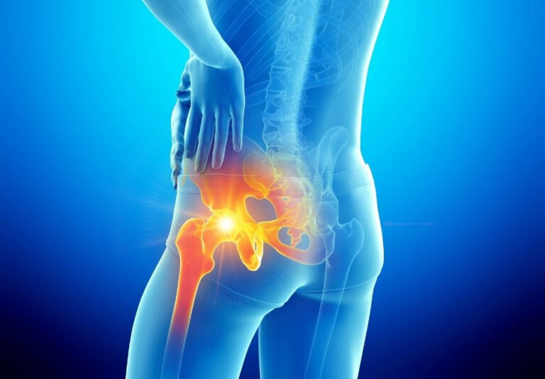Kalça Ve Uyluk Arkasında Gizli Ağrı Nedeni: Posterior Femoral Kutanöz Sinir Sıkışması