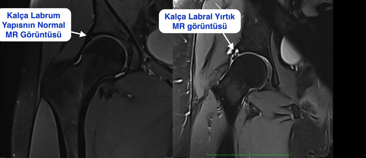 Kalça Labrum Yırtığı MR Görüntüsü