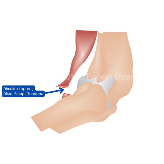 Biceps Tendon Yırtılması – Kopması