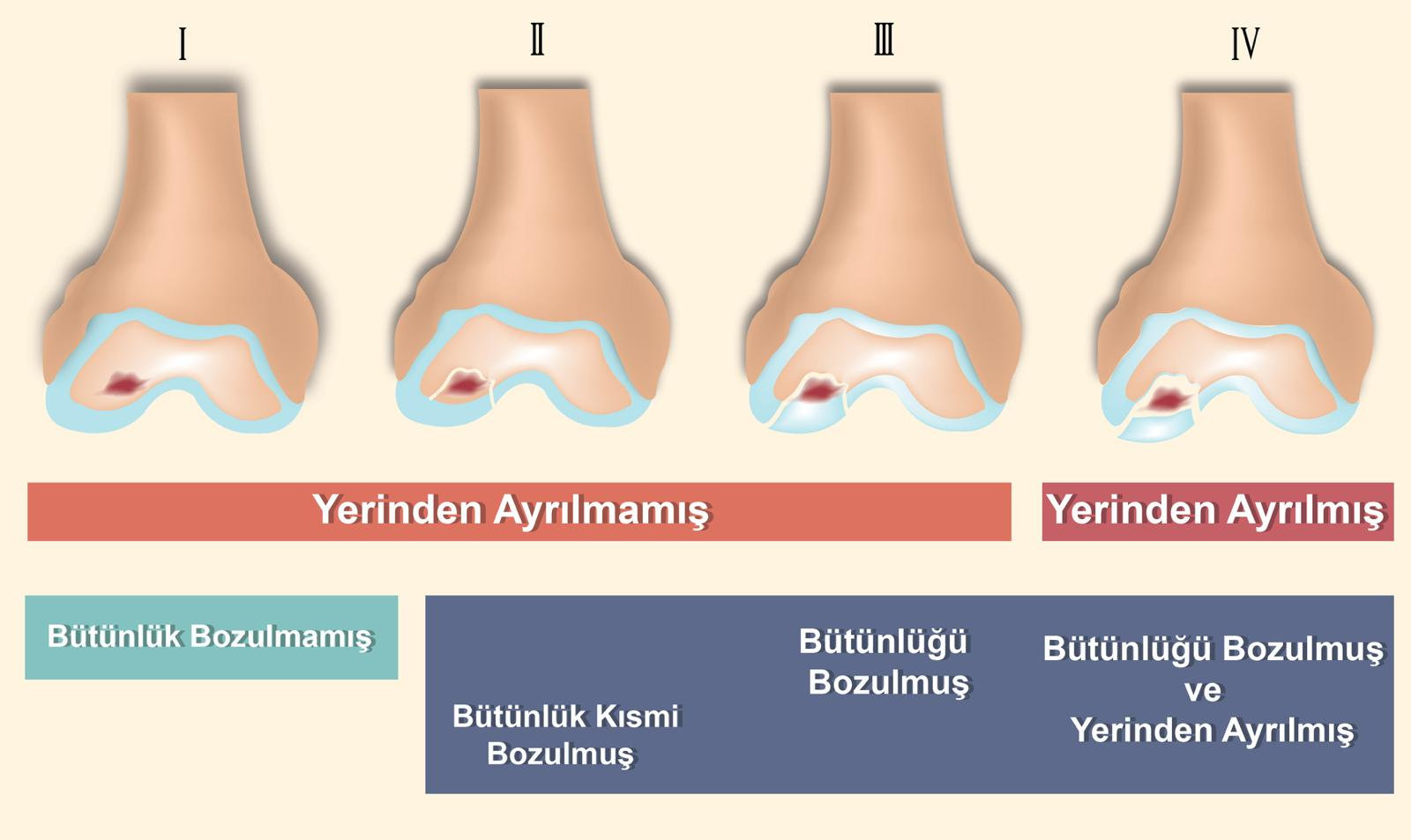 Osteokondritis Dissekans