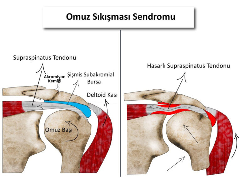Omuz Sıkışma Sendromu Nedir? İmpingement Sendromu