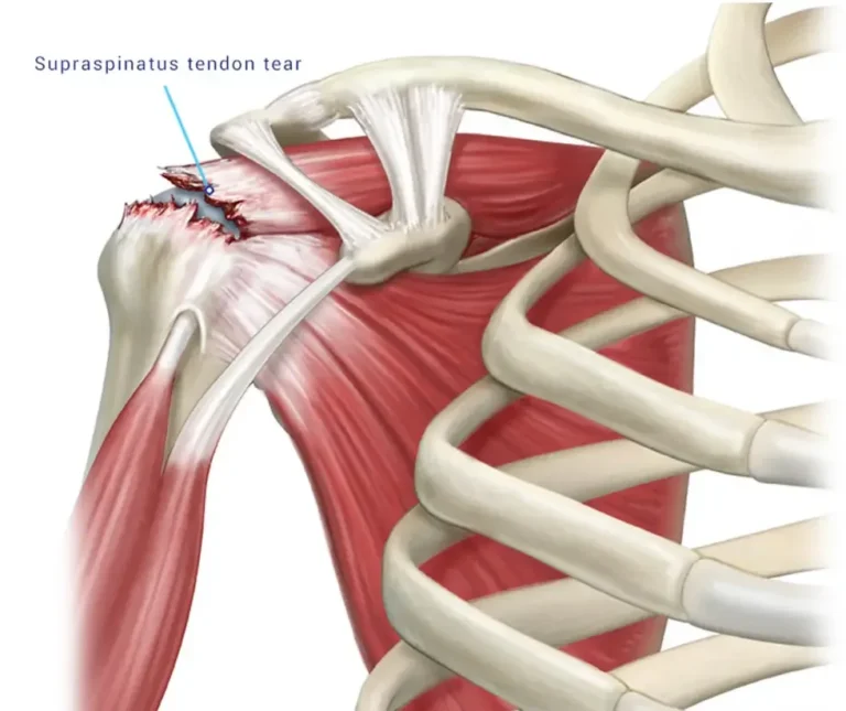 Supraspinatus Tendonu Yırtığı | Rotator Kaf Yırtığı Nedir?