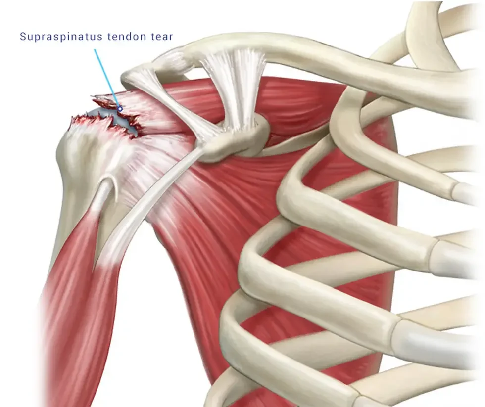 Supraspinatus Tendonu Yırtığı | Rotator Kaf Yırtığı Nedir?