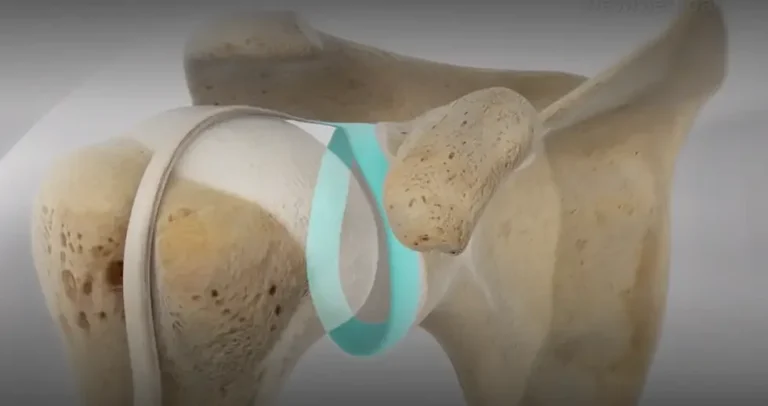 Omuzun SLAP Yırtıkları ve Artroskopik SLAP Tamiri