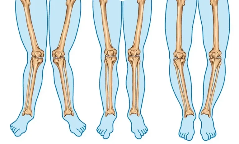 Diz Çevresindeki Eğriliklerin Tedavisi: Yüksek Tibial Osteotmi ve Distal Femoral Osteotomi