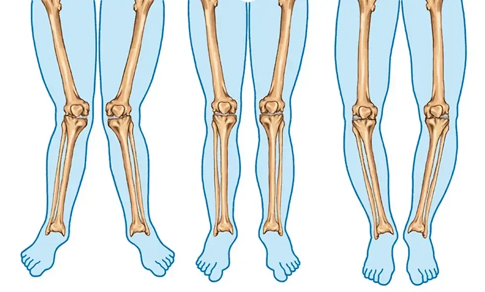 Diz Çevresindeki Eğriliklerin Tedavisi: Yüksek Tibial Osteotmi ve Distal Femoral Osteotomi