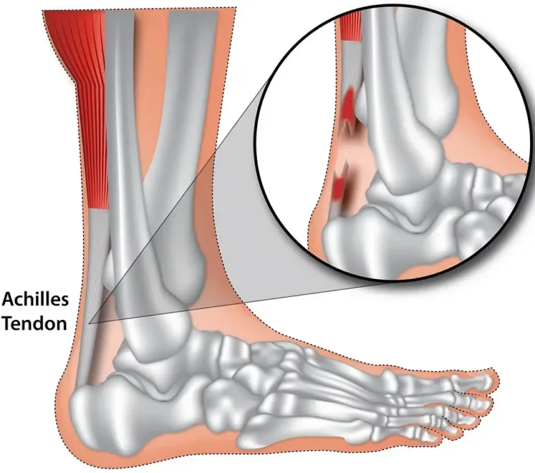 Aşil Tendonu Kopması Nedir? Kaç Ayda İyileşir?