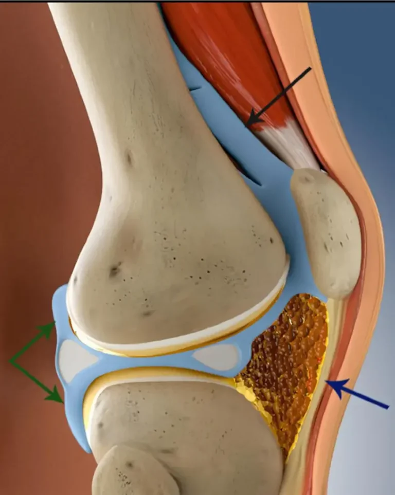 Artrofibrozis Tedavisi