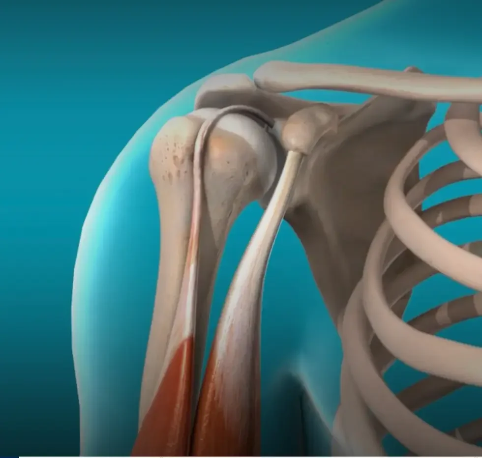 Biceps Tendinit Nedir? Belirtileri ve Ameliyatı