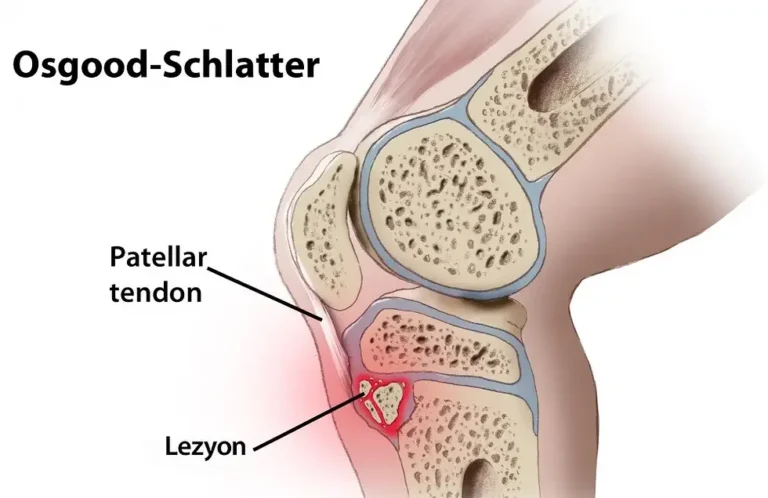 Osgood Schlatter