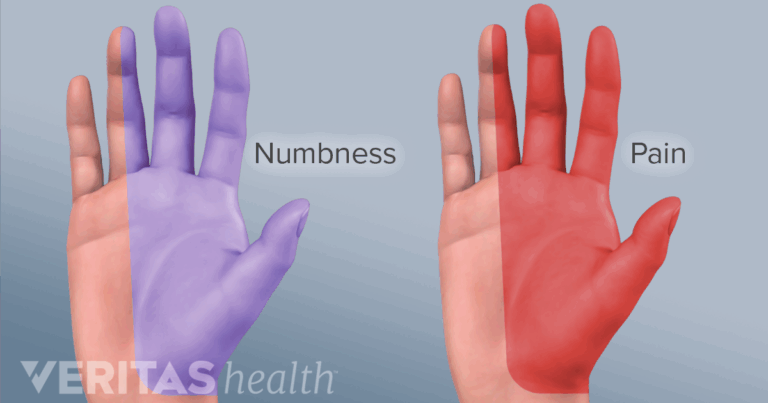 Carpal Tunnel Syndrome