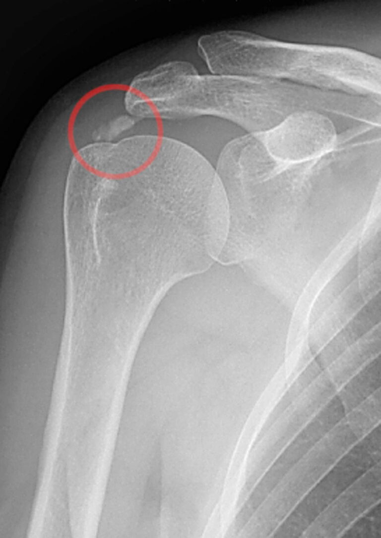 Calcific Tendinitis of the Shoulder