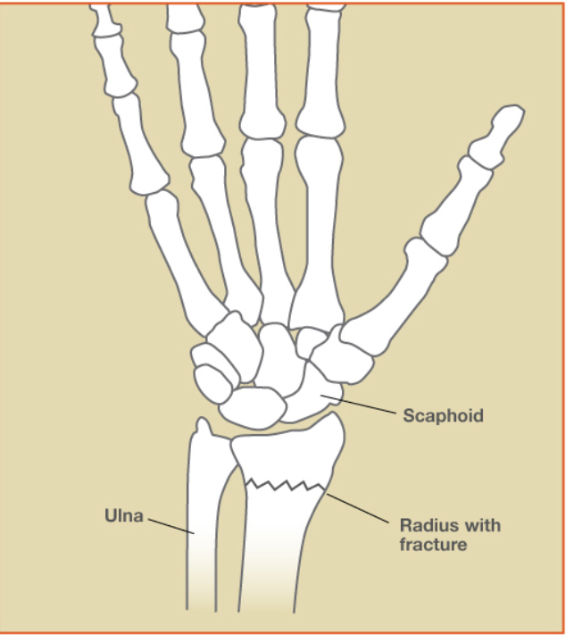 Wrist Fractures
