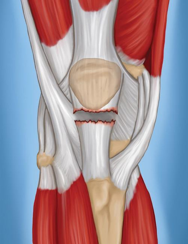 Patellar Tendon Yaralanması ve Ameliyatı