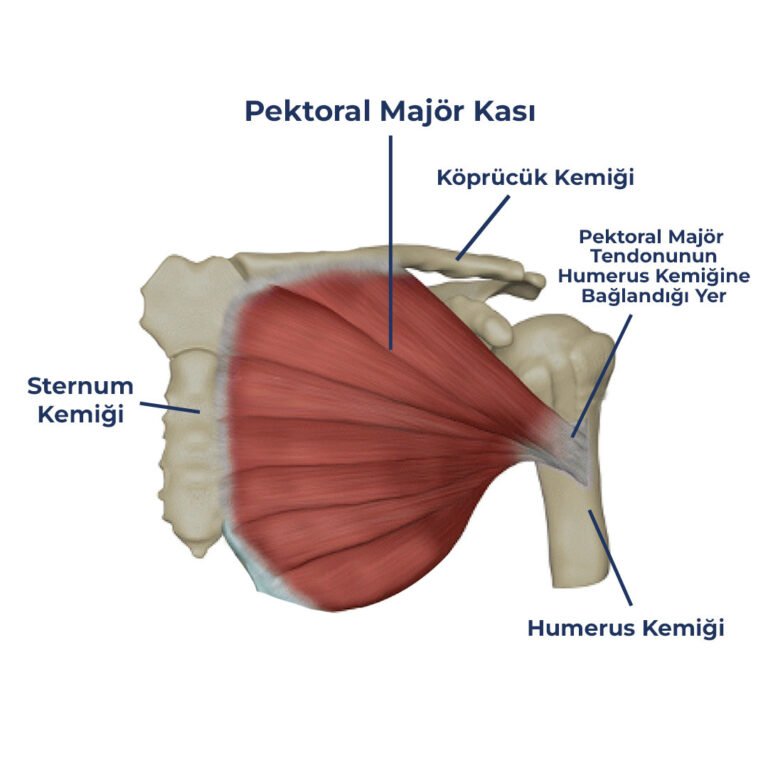 Pektoral Kas Yırtığı