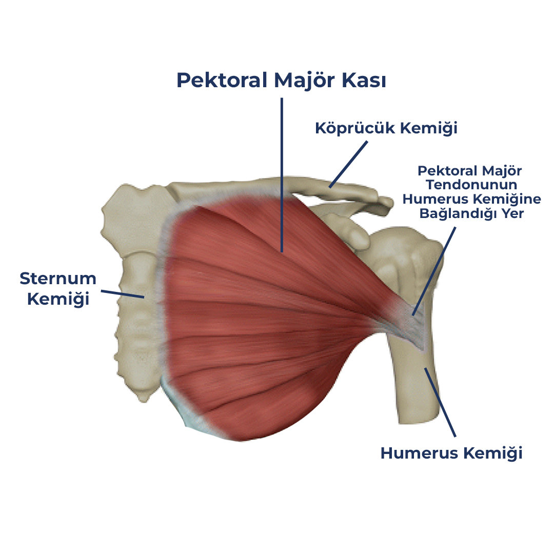 Pektoral Kas Yırtığı