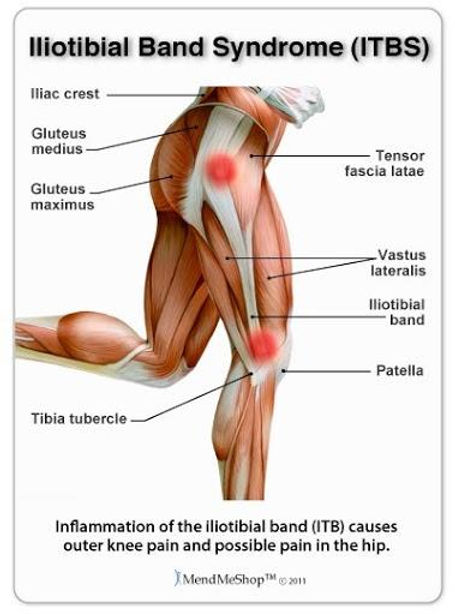 Iliotibial (IT) Band Syndrome