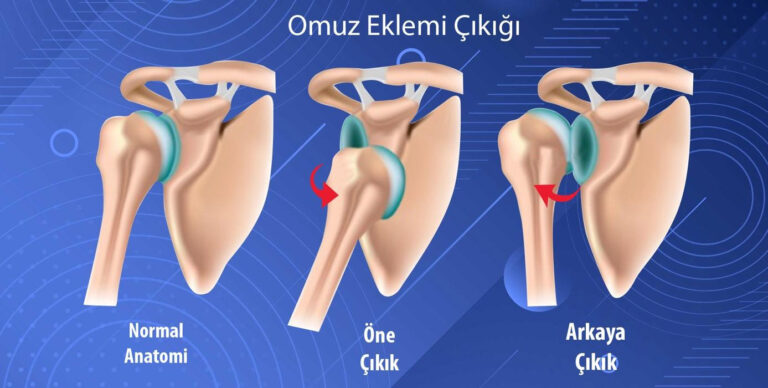 Omuz Çıkığı ve Ameliyatı