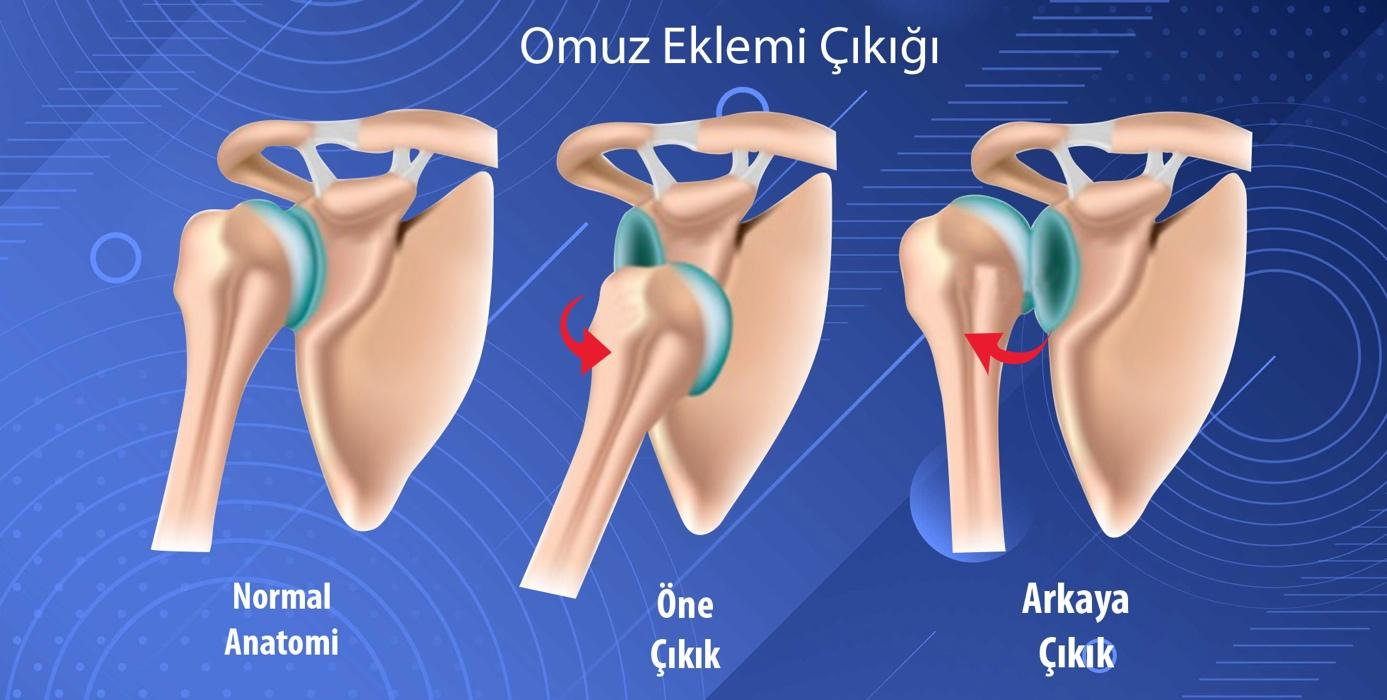 Omuz Çıkığı ve Ameliyatı