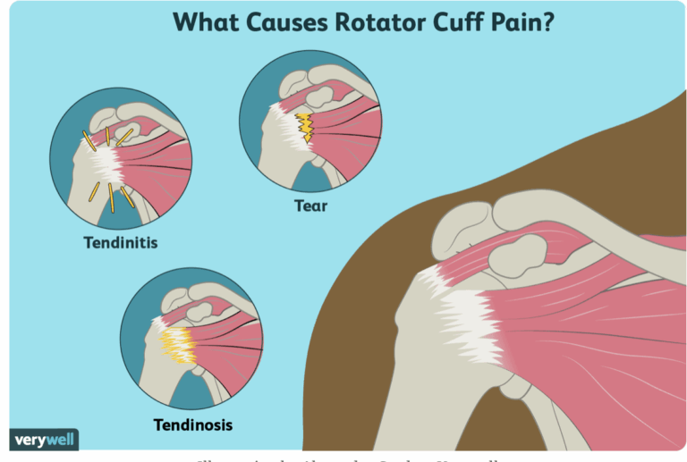 Rotator Cuff Tendiniti