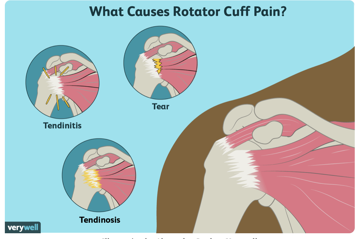 Rotator Cuff Tendiniti