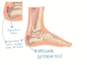 Haglund Deformity