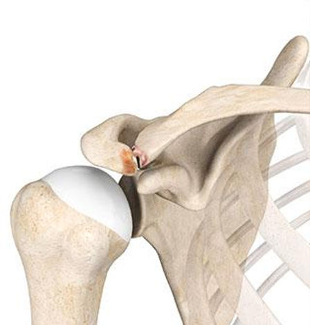 Distal Klavikula Osteolizi (Ağırlıkçı Omuzu)