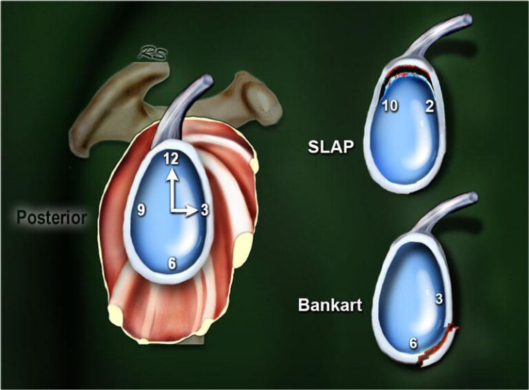 Omuzun Labrum Yırtıkları