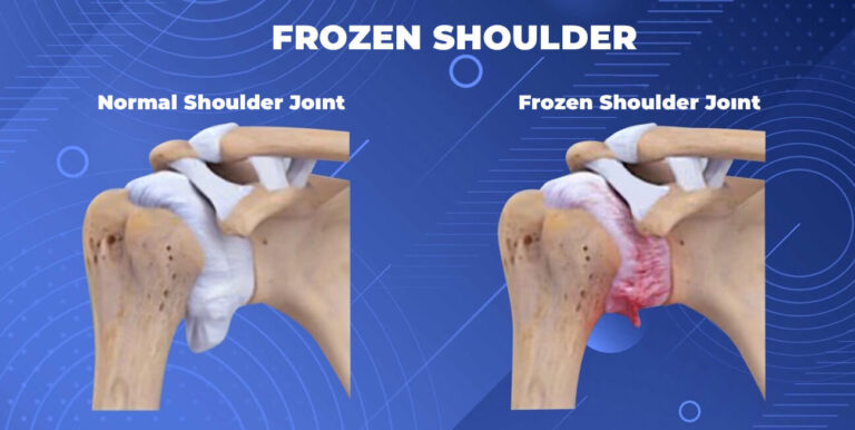 Frozen Shoulder