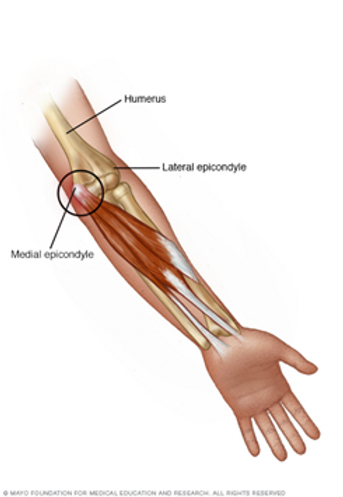 Golfçü Dirseği (Medial Epikondilit)