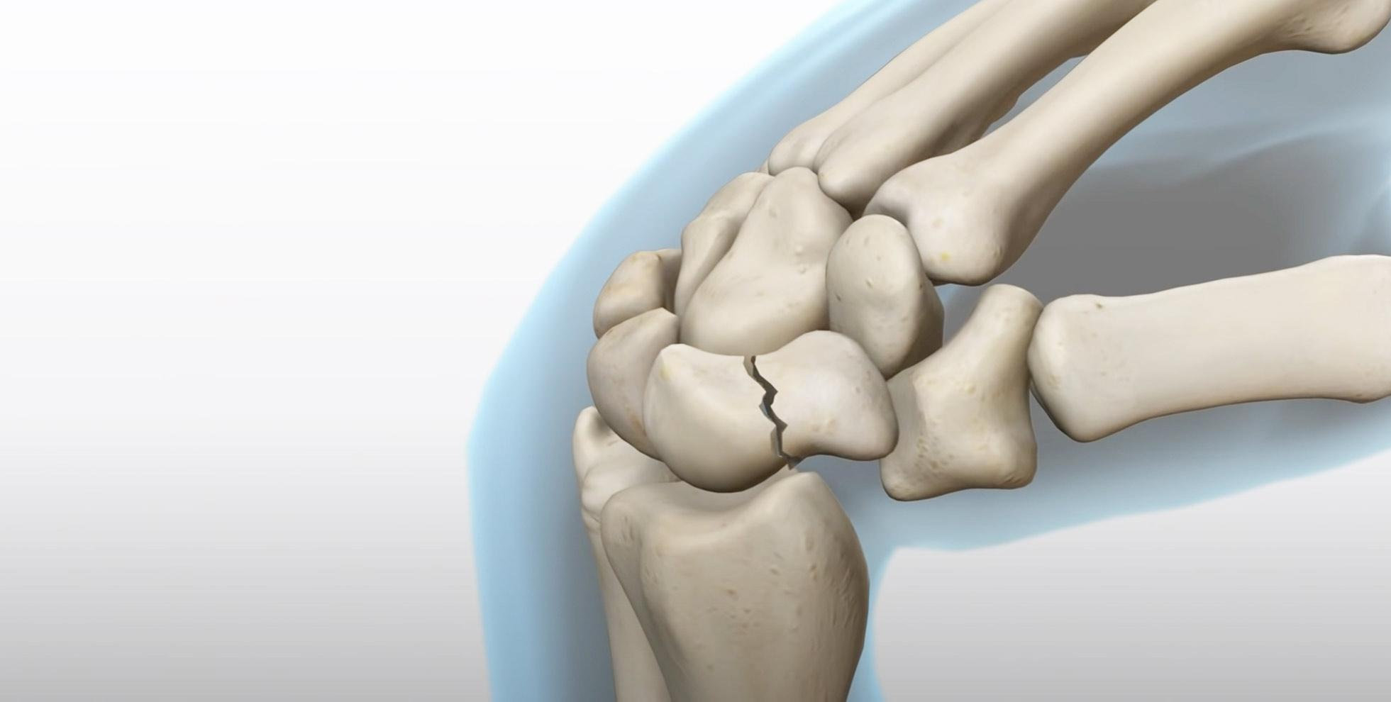 Skafoid Kırığı Nedir? | İyileşme Belirtileri