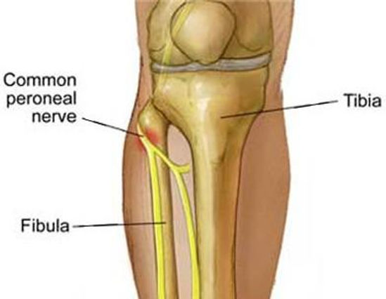 Dizde Sinir Sıkışması – Peroneal Sinir